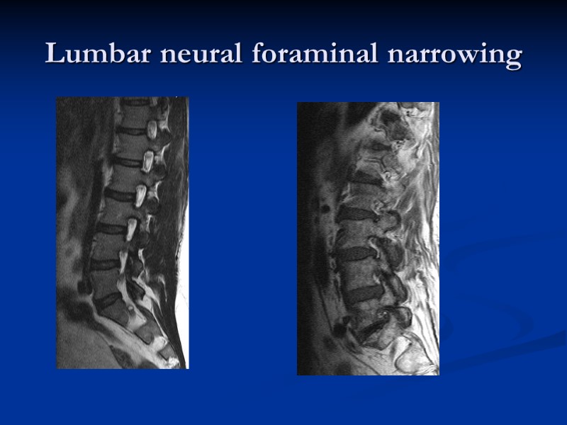 Lumbar neural foraminal narrowing